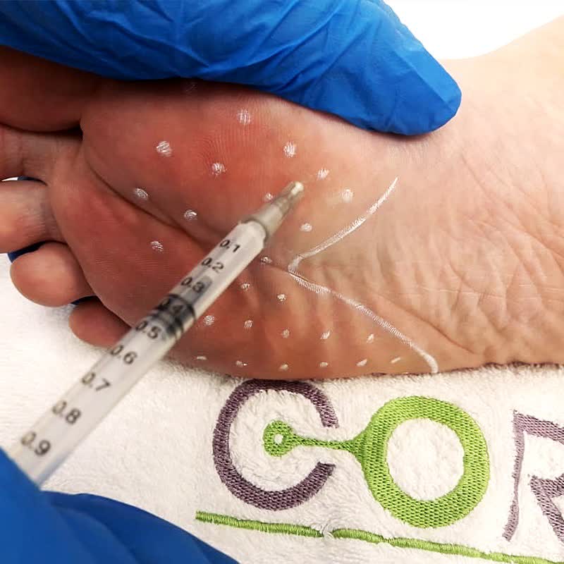 Injection into the back of a hand at Cormedicine